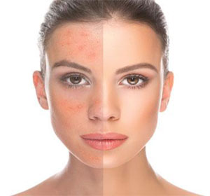 Red clover acne skin change image