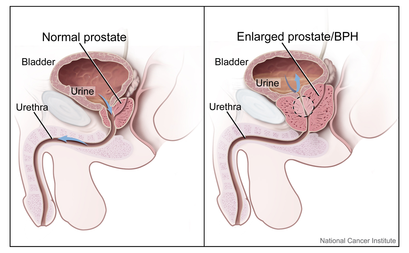 Prostate (normal and Enlarged) image